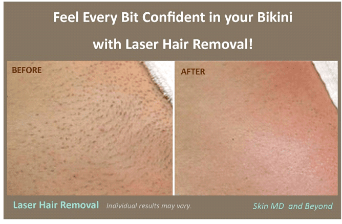 laser hair removal on bikini area reviews