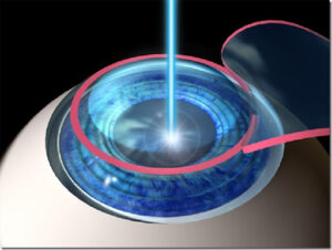 laser lasik eye surgery reviews